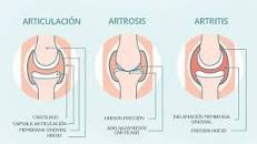 Resultado de imagen para diferencia entre artritis y artrosis