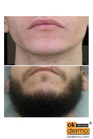 I am now almost 21, have been using minoxidil for 11 months, (really close to 12) and would like to help tell others about my experience yes, see, most people will look at slightly thicker hairs and think it's done, i have a beard now but look at my cheeks, those are transitional hairs, look at my goatee. Morr Topical Lotion 60ml 2fl Oz Okdermo Skin Care