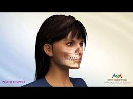 Surgical Orthodontic Treatment for Gummy Smile