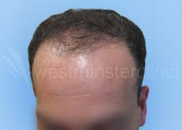 Bald fade with curly top Curly Hair Transplant