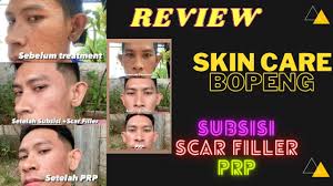 Subsisi adalah tindakan penusukan jarum kecil ke bagian kulit (biasanya wajah) guna merusak atau melepaskan ikatan jaringan di bagian dalam kulit. Skincare Untuk Kulit Bopeng Skin Care After Prp Treatment Youtube