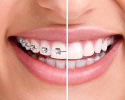 Subtle Invisalign treatment