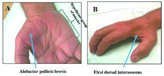 Chlorzoxazone is used to treat muscle spasms/pain. Dissociated Muscle Atrophy Is A Specific Feature Of Als Characterized Download Scientific Diagram