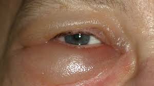 If you felt this information uselful, kindly make a small donation to my paypal : Periorbital Edema Pictures Causes And Treatments And More