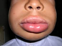 Image result for Angioedema