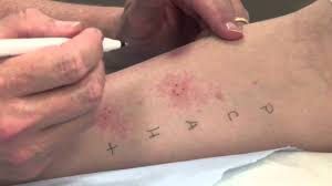 In fact if you live in major metropolitian cities ie nyc, it wouldnt be surprising if you have it. What Does A Positive Tb Test Look Like With Pictures And Videos Actforlibraries Org