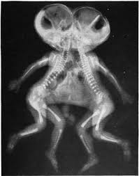 Ladan bijani and laleh bijani in persian january 171974 july 8 2003 were iranian conjoined twin sisters they were joined at the h. Conjoined Twins Wikipedia