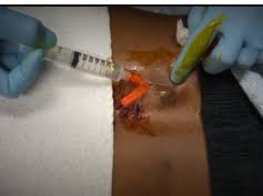 Like a foreign body, diabetes or persistent pressure on the area. Medflixs Abscesses Abscess Removal Drainage And More By Drer
