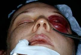 We did not find results for: Orbital Fracture Treatment Denver Orbital Fracture Repair Boulder Co