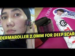 Official derma roller online store sa suppliers of microneedling products & skincare gadgets! Before After Dermarolling Dermaroller 2 0mm How To Use Dermaroller Youtube