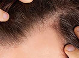Sac Dokulmesine Cozum Ne Iyi Gelir Clinichair Sac Ekimi Izmir