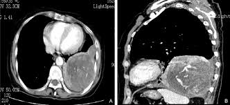 malignant peritoneal mesothelioma (mpem) is a rare cancer of the mesothelial cells of the peritoneum. Figure 1 From Massive Localized Malignant Pleural Mesothelioma Lmpm Manifestations On Computed Tomography In 6 Cases Semantic Scholar