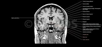 Brain Coronal Section Basal Nuclei And Related Structures Corpus Callosum Septum Pellucidum Radiology Brain Anatomy Anatomy