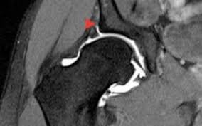 Image result for Hip Labral Tear