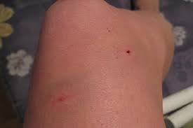 Sweet bites / tian mei de yao hen / 甜美的咬痕. Leerburg Emails About Dog Bites And Dog Attacks