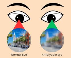 Image result for Amblyopia