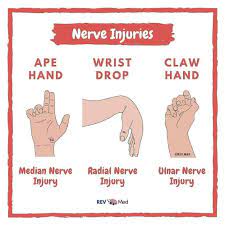 Read More And Download Book Immediately Repost Medical Graph Median Nerve Ape Hand Compression Of The Median Nerve Median Nerve Nursing Books Nerve Anatomy