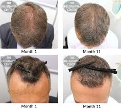 I'm julio deus, the founder and editor of hairlossrestorationreviews.com. Hair Growth Success Incredible Results Highly Recommended