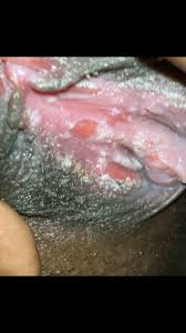 Though candida fungi live all over the body, if they become. Yeast Infection Or Something Else Candida Genital Forums Patient