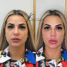 Veja o antes e depois da harmonização de Deolane Bezerra