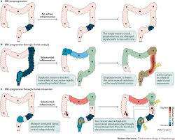 Small bowel cancers include adenocarcinomas, carcinoid tumours, lymphomas, and leimyosarcomas. Clonal Evolution Of Colorectal Cancer In Ibd Nature Reviews Gastroenterology Hepatology