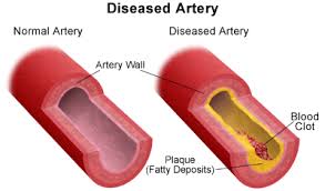 Image result for coronary block