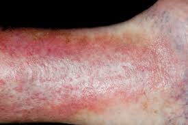 Image result for itchy skin rectum