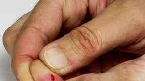 When A Cut Finger Is More Serious Than It Might Seem