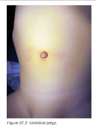 Image result for Umbilicus botryoides