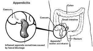 Image result for Appendicitis