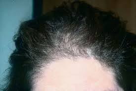 I used a bar of coal tar soap on patient the other day, he had it in his toilet bag, i was immediately wrights traditional is soothing, cleansing. Hair And Scalp Disorders Resulting In Hair Loss Plastic Surgery Key