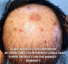 Different types of hair loss require different approaches. Beware Of Fake Toppik Product In The Market Updated March 2017 Toppik Malaysia
