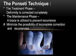 Developing a referral system to an accessible network of clubfoot. Ponseti Method For The Treatment Of Congenital Clubfoot Ccf Ppt Download