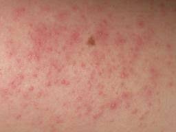 Another area susceptible of ingrown hair are the legs and inner thighs especially the upper inner thighs (not to forget your groin area). Ingrown Hair Cyst Treatments Causes And Prevention