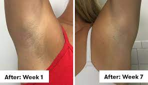 Laser hair reduction reduces hair growth using high energy light concentrated into the hair follicle. I Tried Laser Hair Removal Under My Arms And I Ll Never Shave Again Self