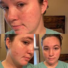 I had a dream that my face is full of big big pimples and am trying to  remove them but they are very Strong