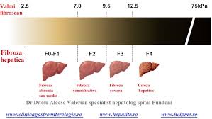 Prin hepatită se înțelege în primul rând inflamarea ficatului și, de asemenea, ne referim la un grup de infecții virale care ne afectează ficatul. Fibroza Si Ciroza Hepatica Fibroscanul Si Biopsia Hepatica Cabinet De Gastroenterologie Si Hepatologie Bucuresti 0758 751 841 Cabinet De Gastroenterologie Si Hepatologie Bucuresti 0758 751 841