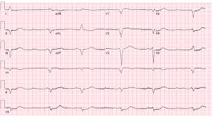 Normal troponin and normal ecg would rule out almost all cases of myocarditis. Autoimmune Myocarditis With Av Block Too Much Of A Good Thing American College Of Cardiology