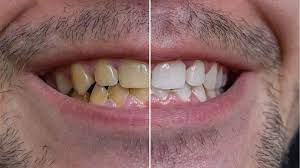 10 Ways To Clean Yellow Teeth Naturally Yellow Teeth Tooth Sensitivity Stained Teeth