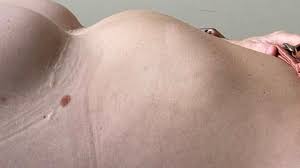 Generally, the patients present for treatment of the chest deformity and breast asymmetry. Sunken Chest Syndrome I M Being Strangled Inside Bbc News