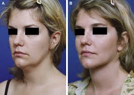 Serendipity in Ultimate Neck Lift Correction