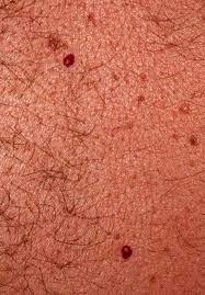 Perform biopsy on lesions in. Cherry Angioma Cherry Hemangioma Senile Angioma Campbell De Morgan Spot Dermatology Advisor