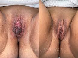 Labiaplasty Before & After Photos | Ennis Plastic Surgery in Boca Raton