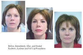 Picture taken prior to follow up proceedure. Permanent Makeup Wikipedia