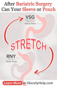 Does Pouch Size Matter Will The Stomach Stretch After Bariatric Surgery In 2020 Bariatric Surgery Stomach Stretches Bariatric