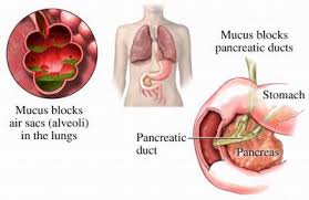 cystic-fibrosis-treatment-drug