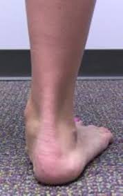 Tarsal on outside of foot. Adult Acquired Flatfoot Orthoinfo Aaos