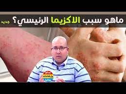 ماهو سبب الاكزيما الرئيسي وصفة طبيعية لعلاج الاكزيما مع الدكتور عماد ميزاب youtube mens tops polo shirt men