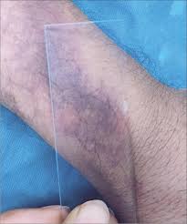 Image result for Diascopy