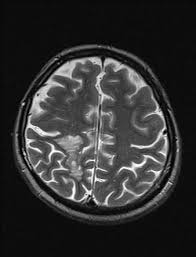 We did not find results for: Balo Concentric Sclerosis Radiology Reference Article Radiopaedia Org